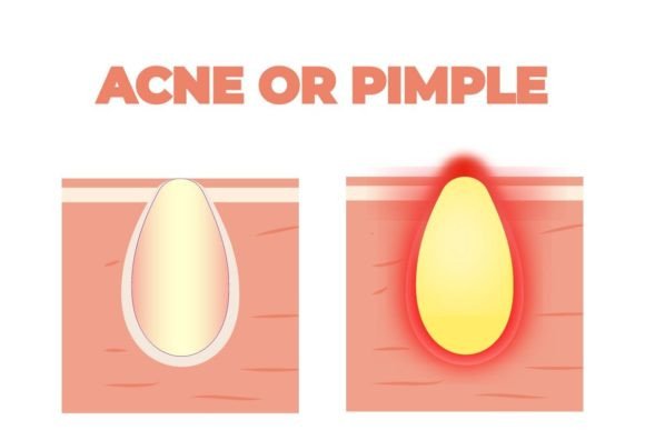 Download Acne Growing with Pus on the Skin Vector - Pus Collection